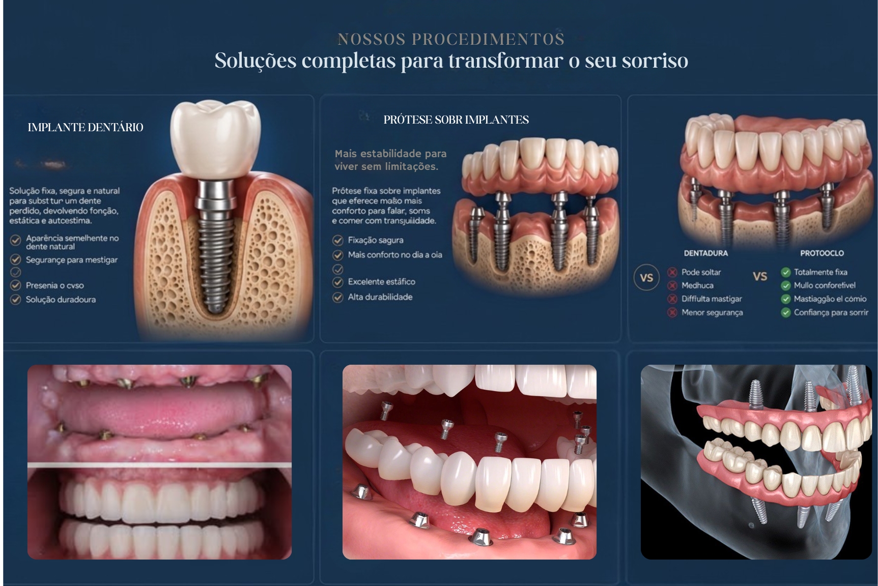 Ilustrações de implante dentário, prótese sobre implantes, protocolo, reabilitação oral, enxerto ósseo e carga imediata